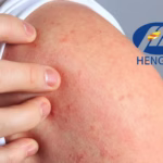 Hengrui Pharma Submits Ivarmacitinib Ointment for AD Treatment Approval