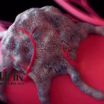 Konruns Pharmaceutical's KC1036 Enters Phase II Trial for Ewing’s Sarcoma in Adolescents