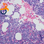 IASO Bio's Fucaso NDA Accepted by Hong Kong DOH for Relapsed/Refractory Multiple Myeloma