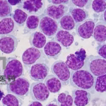 Huadong Medicine HDM2005 Orphan Drug Designation