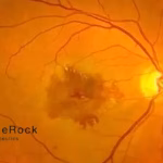 Bayer's BlueRock Therapeutics Gets Fast Track for OpCT-001 Therapy