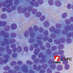 CSPC Pharmaceutical's Sirolimus Receives BTD for Malignant PEComa Treatment
