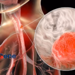 BeiGene's Tevimbra Receives FDA Approval for ESCC Treatment