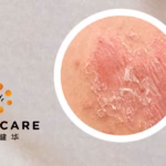 InnoCare Pharma Presents Positive Phase II Results of ICP-488 in Psoriasis at AAD Meeting