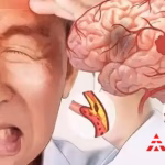 Tasly Pharma's NR-20201 Receives NMPA Approval for Acute Ischemic Stroke Trial