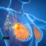 Joyo Pharma's JYP0035 Receives Clinical Trial Approval for Breast Cancer Treatment