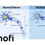 Sanofi's Tolebrutinib Accepted for FDA Review in Non-Relapsing Secondary Progressive Multiple Sclerosis