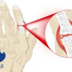 Hengrui Pharmaceuticals' Ivarmacitinib Approved for Rheumatoid Arthritis in China