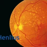 Henlius Biotech's HLX04-O Shows Positive Results in wAMD Phase III Trial