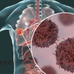 BeiGene Halts Ociperlimab Clinical Program for Lung Cancer