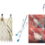 Peijia Medical's ReachTactile Robot Assists First Human TAVR Trial