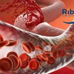 Suzhou Ribo Life Science Completes Enrollment for Phase IIa Study of FXI-Targeted siRNA Drug RBD4059