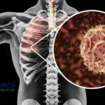 Phanes Therapeutics Gains CDE Approval for Peluntamig Phase II Trial in SCLC and NEC