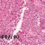 Sichuan Biokin Launches Phase III Trial for BL-B01D1 in Urothelial Carcinoma