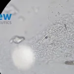 IVIEW Therapeutics' IVIEW-1201 Gains FDA Orphan Drug Designation for Fungal Keratitis