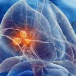 Hansoh's HS-20093 ADC Earns BTD for Advanced NSCLC from China's NMPA