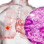 Suzhou Zelgen Gains NMPA Approval for ZG006 in Small Cell Lung Cancer Study