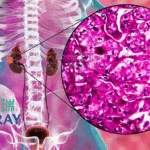 iMBIORAY Gains NMPA Approval for Phase IITrial of IBR854 in Advanced RCC