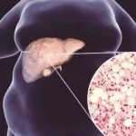 Doer Biologics Begins Phase II Study of DR10624 for Steatotic Liver Disease