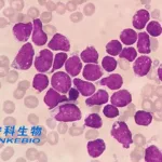 Anhui Anke's Allogeneic CAR-T Therapy UTAA09 Approved for r/r B-ALL Trials