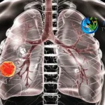 TYK Medicines Submits Pre-NDA Package for Asandeutertinib in NSCLC Brain Metastasis