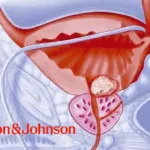 Johnson & Johnson's TAR-200 Shows Promising Results in Phase IIb SunRISe-1 Study for Bladder Cancer