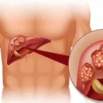 Bayer AG Launches Phase I Study of 225Ac-GPC3 for Advanced Hepatocellular Carcinoma