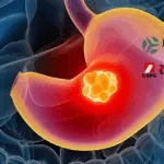 Alphamab and CSPC Announce Positive Interim Results for KN026 in HER2+ Gastric Cancer Trial