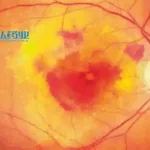 Chengdu Origen Announces First Patient Dosing of KH658 in Wet AMD Trial