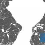 Guilin Sanjin's BC006 Monoclonal Antibody Gains NMPA Approval for IPF Trials
