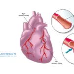 Shuangcheng Pharma's Generic Bivalirudin Approved by Australia's TGA