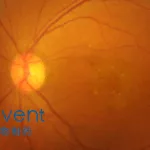 Innovent Biologics Completes First Dosing in Phase II Study for Efdamrofusp Alfa in DME