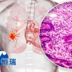 Hengrui Pharmaceuticals Gains NMPA Clearance for SHR-1316 (sc) in ES-SCLC Trial