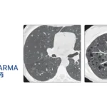 Fosun Pharma's FCN-159 Granted Breakthrough Therapy Designation for Pediatric LCH
