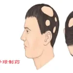 Zelgen Biopharmaceuticals Submits New Indication Application for Jacktinib in Severe Alopecia Areata