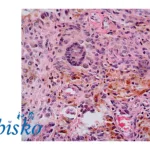 Abbisko's Pimitinib Granted Priority Review for TGCT Treatment in China