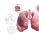 Nuance Pharma's Ohtuvayre Meets Primary Endpoints in COPD Study