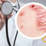 Ascletis Pharma Starts Phase I Study of ASC50 for Psoriasis in the US