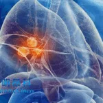 ImmuneOnco and Instil Bio Announce Clinical Updates for IMM2510 in NSCLC