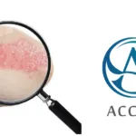 Accropeutics' AC-201 Shows Positive Phase II Results in Psoriasis Treatment