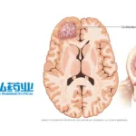 Kanghong Pharma Wins NMPA Approval for KH617 in Glioblastoma Trial