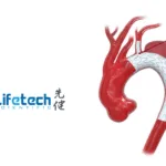 China's NMPA Approves Lifetech's Aortic Fenestration Stent System