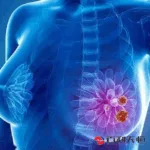 Biokin Pharma Enrolls First Patient in BL-M07D1 Phase III Trial for HER2 Low Breast Cancer