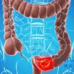 Innovent Biologics Presents IBI363 Clinical Results at 2025 ASCO Annual Meeting