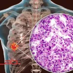 Zai Lab Presents ZL-1310 Clinical Results for Small Cell Lung Cancer at ASCO