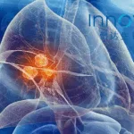 Innovent Biologics' IBI363 Receives Breakthrough Therapy Designation from CDE