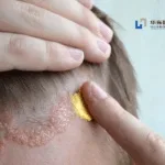 Huadong Medicine Receives NMPA Approval for Phase III Trial of Roflumilast Foam