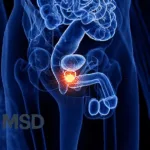 MSD Initiates IDeate-Prostate01 Phase III Trial of Ifinatamab Deruxtecan for mCRPC