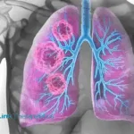 Medilink Therapeutics' YL201 Wins FDA Breakthrough Therapy Designation for SCLC