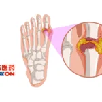 Livzon's YJH-012 siRNA Drug Gets NMPA Green Light for Gout Trials